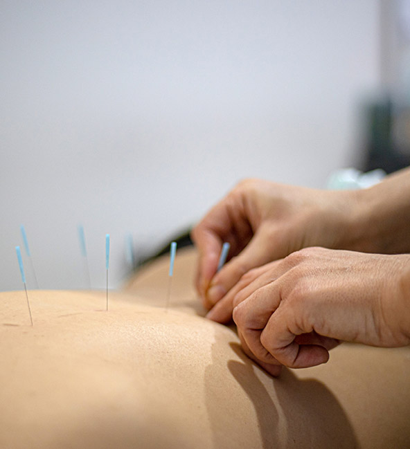 Acupuntura